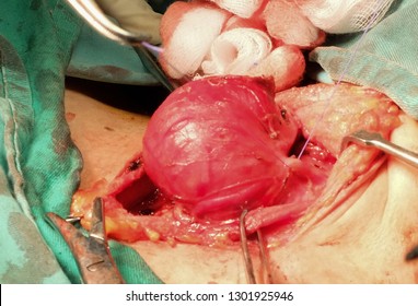 Surgeon performing surgical removal of thyroid gland called Hemithyroidectomy for thyroid Cyst.