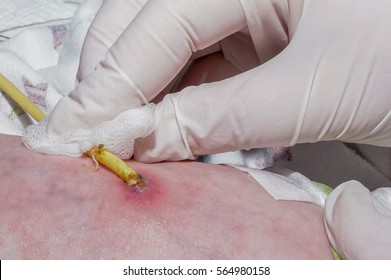 Surgeon Performs Postoperative Wound Care After Gastrostomy Of Newborn Baby With Esophageal Atresia In Neonatal Intensive Care Unit