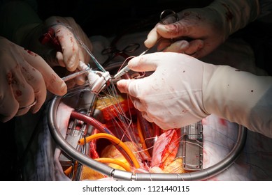 Surgeon Is Placing Stitches On Artificial Heart Valve During Open Heart Surgery