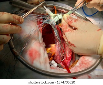 Surgeon Is Placing Stitches On Prosthetic Heart Valve During Open Heart Surgery.