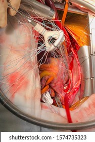 Surgeon Is Placing Stitches On Prosthetic Heart Valve During Open Heart Surgery.