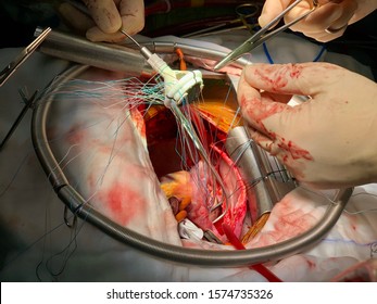 Surgeon Is Placing Stitches On Prosthetic Heart Valve During Open Heart Surgery.