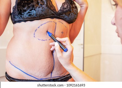 surgeon preparing woman for liposuction surgery