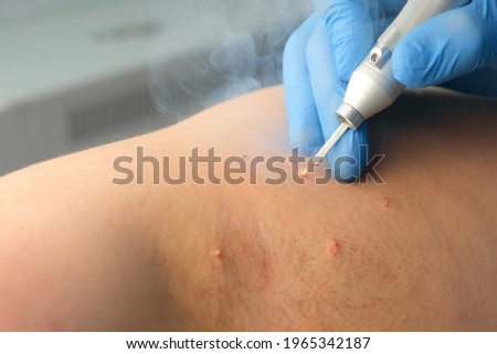 Surgeon removing many small papillomas using laser on man's body, burning skin, closeup view. One day surgery concept. Removing nevus, mola, papilloma or birthmark, surgical procedure. Foto stock © 