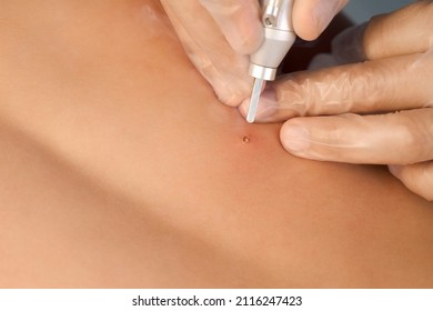 Surgeon Removing Mole On Teen Boy's Spine Using Laser In Hospital, Hands In Gloves Closeup. Remove Nevus On Back. One Day Surgery Concept. Sore And Wound After Operation.