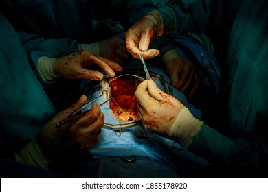 Surgeon Is Tying Knots On The Open Heart On Mechanical Heart Valve Implantation.