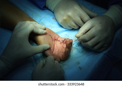 Surgeons Finished The Surgery On A Hand