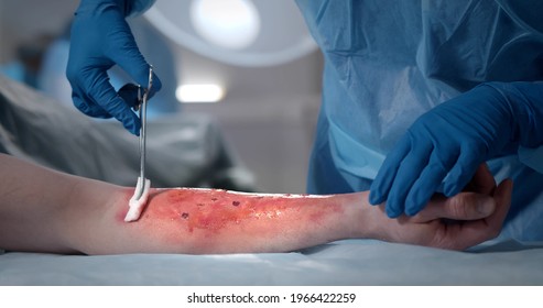 Surgeons team working with burn wound on arm of patient in operating room. Close up of medics disinfecting burn wound of patient in operating room - Powered by Shutterstock