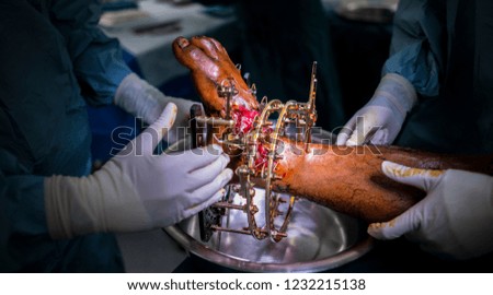 Surgeons/Doctors held the ring external fixator in his hand after fixation the broken bone in severe foot and ankle injury after motor vehicle accident. Dark background 
