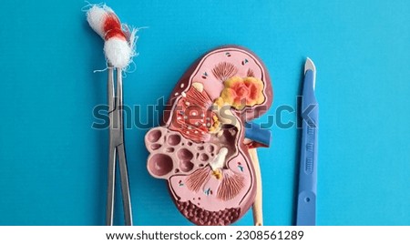 Surgery of adrenal glands and anatomy of kidney. Surgery for cancer, tumor, pheochromocytoma and adenoma