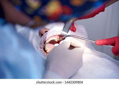 Surgery in the dental clinic. Sinus lifting operation.Stage Dental implantation.