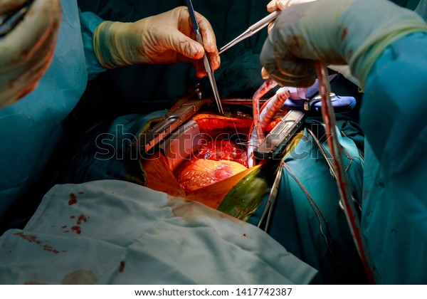 Surgery\
doctor in surgery center for open heart\
surgery