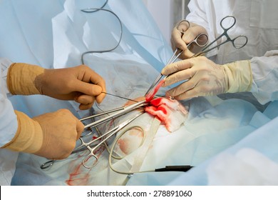 Surgery, Gallbladder Removal