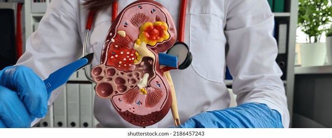 Surgery of kidneys and adrenal glands is medical surgical intervention. Doctor holds in one hand model of kidney with ureter and scalpel surgical operation to treat or remove - Shutterstock ID 2186457243
