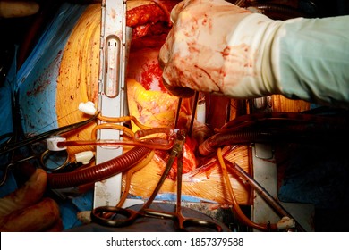 Surgery Minimally Invasive Surgery Patient During A Heart Surgery At A Hospital In The Surgical Operating Room