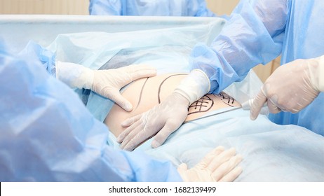 Surgery room. Belly surgery. Doctor mark liposuction area at tummy. Drawing at skin. Anti cellulite equipment. Copy space. Light blue color. Fat abdomen. Hostipal doctor hands - Shutterstock ID 1682139499