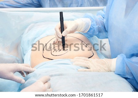 Surgery room. Belly surgery. Doctor mark liposuction area at tummy. Drawing at skin. Anti cellulite equipment. Copy space. Light blue color. Fat abdomen. Hostipal doctor hands