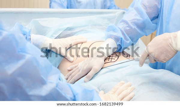 Surgery room. Belly\
surgery. Doctor mark liposuction area at tummy. Drawing at skin.\
Anti cellulite equipment. Copy space. Light blue color. Fat\
abdomen. Hostipal doctor\
hands