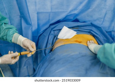 Surgery in a sterile setting. A surgical team is conducting a procedure, maintaining a sterile environment while focusing on a patient's abdomen. - Powered by Shutterstock