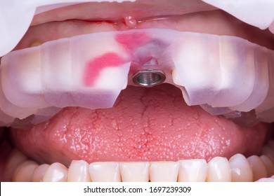 Surgical guide. The stage of dental implantation in the front of the upper jaw using a surgical guide printed on a 3D printer. - Shutterstock ID 1697239309
