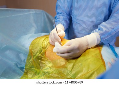 Surgical Operation Scalpel Doctor Scalpel Stock Photo 1174006789 ...