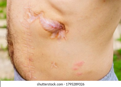 Surgical Scar After Pancreatic Surgery.