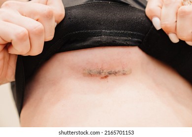 Surgical Sewing. A Young Woman In Black Compression Underwear After Mammoplasty. Corset During The Rehabilitation Period After Plastic Surgery. Postoperative Clothing.