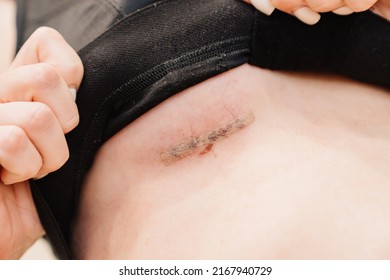 Surgical Sewing. A Young Woman In Black Compression Underwear After Mammoplasty. Corset During The Rehabilitation Period After Plastic Surgery. Postoperative Clothing.