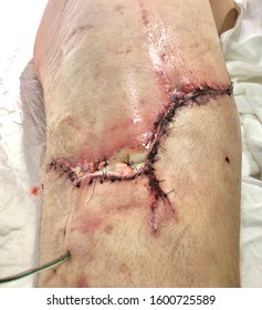 Surgical Site Infection In Case Laceration Wound At Right Hip With Severe Contamination From Soil.