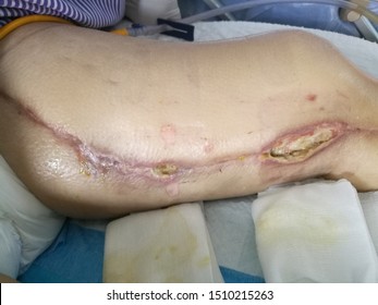 Surgical Site Infection Of Left Greater Saphenous Vein Strapping Site After Heart Surgery