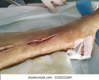 surgical site infection of left greater saphenous vein strapping site after heart surgery
