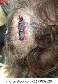 stapled head wound