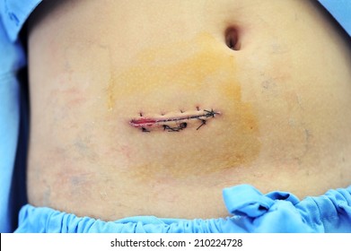 Surgical stitches,suture wound at abdomen.