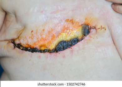 Surgical Suture, Breast Cancer. Burn After Radiation Therapy. Amputation Of The Female Breast.