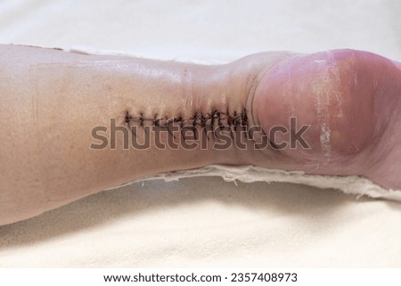 Surgical suture on the leg after surgical treatment of an Achilles tendon tear