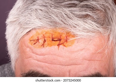 A Surgical Suture Treated With Iodine Solution On The Forehead Of An Elderly Man Close-up Wound Care.