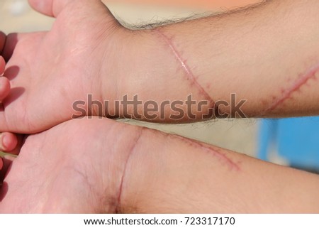 surgical wound stock photo edit now 723317170 shutterstock