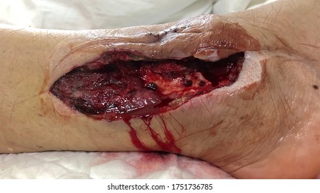 The Surgical Wound At Lateral Site Of Right Ankle In Case Chronic Osteomyelitis.