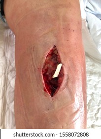 The Surgical Wound At Left Leg In Case Complicated Skin And Soft Tissue Infection.