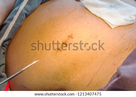 surgical wound man after remove appendix stock photo edit now
