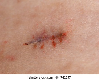 surgical wound with stitches removed antiseptic iodine tincture