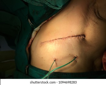 Surgicall Wound After Modified Radical Mastectomy Done ,  Breast Cancer Treatment Procedure .