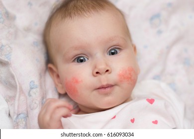 Surprised little baby girl with an allergic rash on her cheeks lies on her back