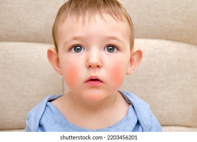 Surprised Toddler Baby With Allergies On The Face, Sofa In The Home Living Room. Portrait Of A Sad Allergic Child With Red Cheeks. Kid Age One Year And Two Months