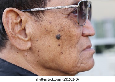 suspicious mole on skin of an old guy