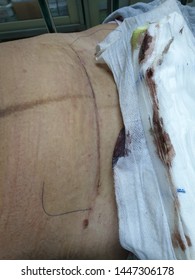 Suture Wounds After A Caesarean Section, Dry Wound Waiting To Be Cut Nylon
