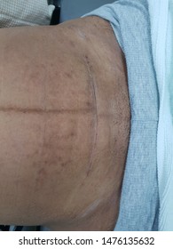 Suture Wounds After A Caesarean Section, Dry Wound Waiting To Be Cut Nylon