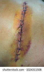 sutures wound. Close up
