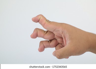 Swan Neck Deformity 3 Fingers