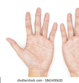 Sweaty Palms Of Asian Young Man. Isolated On White Background.